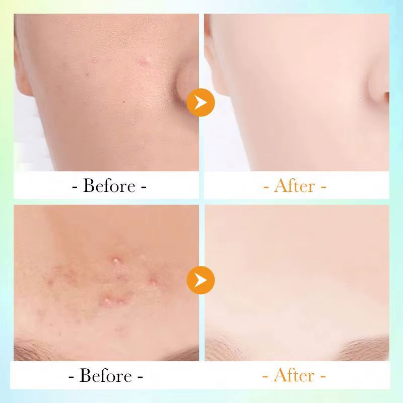 Private Label Salicylic Acid Vitamin C Acne Removal Repair Mask Bubble Mousse Exfoliating Spray Whitening Skin Care Set