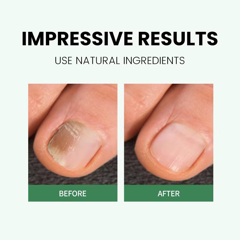 Wholesale Korean Nail Care Products Personal Nail Fungus Pen for Toenail & Fingernail Treatment Cuticle Oil Repair Pen